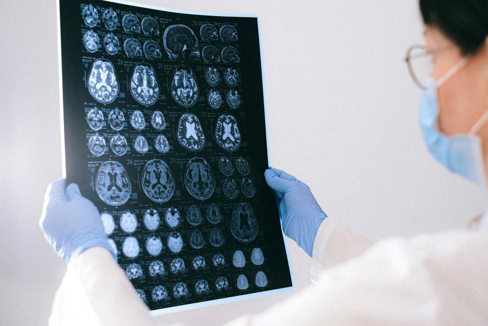 penyakit alzheimer adalah